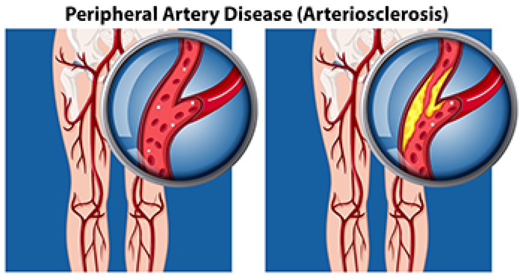 How Peripheral Artery Disease Affects Foot and Ankle Skin