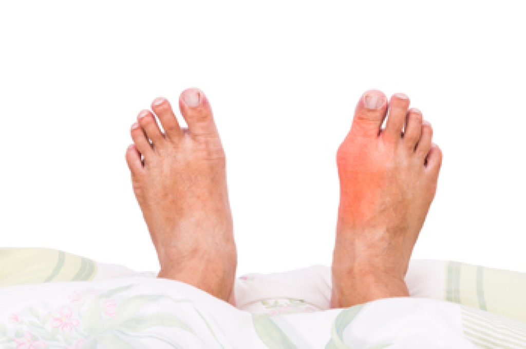 Facts About Bunions